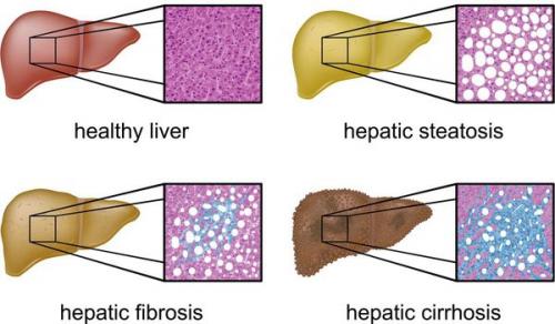 Функции печени в нормализации избыточного веса. Диетотерапия и модификация образа жизни 03 Функции печени в нормализации избыточного веса. Диетотерапия и модификация образа жизни 03