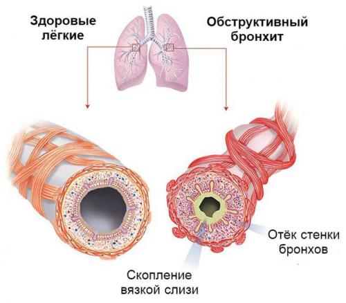 Как избавиться от мокроты. 10 лучших отхаркивающих средств для выведения мокроты у взрослых 04