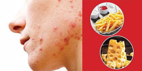 Какие сладости можно при акне. АКНЕ И ДИЕТА: МОЛОЧНЫЕ ПРОДУКТЫ, ЖИРЫ И УГЛЕВОДЫ