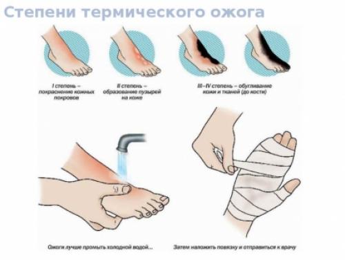 Как оказать помощь при ожоге. Оказание первой помощи при ожогах
