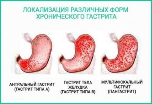 Что можно есть при гастрите желудка. Воспаление слизистой желудка: диета при гиперацидном гастрите 02