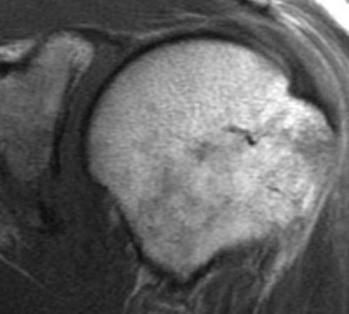 Плечевая боль: как отличить травму от заболевания 01