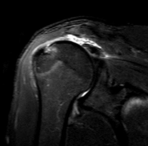 Плечевая боль: как отличить травму от заболевания 02