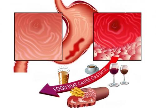Гастрит желудка и кишечника. Классификация 05