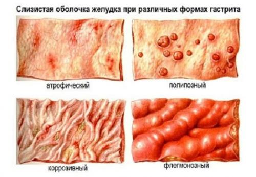 Как лечить острый гастрит. Классификация гастрита 01 Как лечить острый гастрит. Классификация гастрита 01