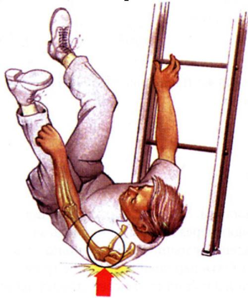 Как оказать первую помощь при травмах конечностей. Оказание первой помощи при травмах опорно-двигательного аппарата