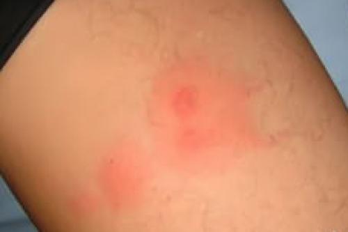 Как оказать первую помощь при укусах насекомых. Как оказать первую помощь при укусе насекомых?