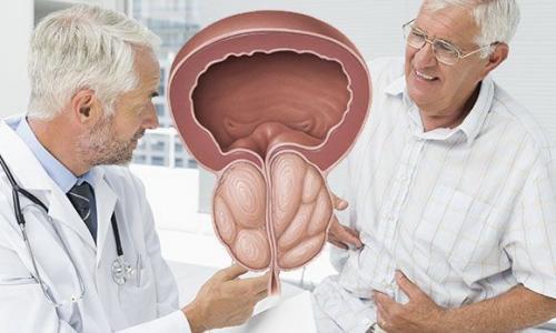 Как вылечить аденому предстательной железы. Все об аденоме простаты и новационных методах ее лечения 01 Как вылечить аденому предстательной железы. Все об аденоме простаты и новационных методах ее лечения 01