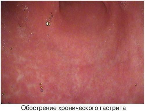 Гастрит желудка у взрослых. Определение болезни. Причины заболевания 01 Гастрит желудка у взрослых. Определение болезни. Причины заболевания 01