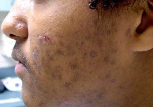 Как убрать возрастные пигментные пятна. Симптомы гиперпигментации кожи 03 Как убрать возрастные пигментные пятна. Симптомы гиперпигментации кожи 03