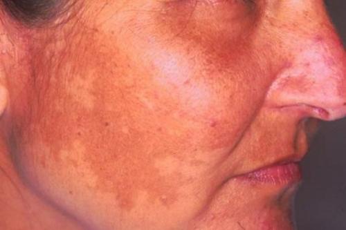 Как убрать возрастные пигментные пятна. Симптомы гиперпигментации кожи 01 Как убрать возрастные пигментные пятна. Симптомы гиперпигментации кожи 01