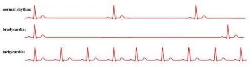 Лечение нарушений ритма сердца. Определение болезни. Причины заболевания 01 Лечение нарушений ритма сердца. Определение болезни. Причины заболевания 01