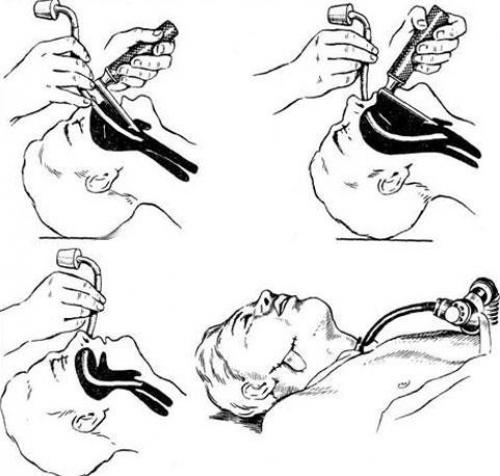 Как провести интубацию