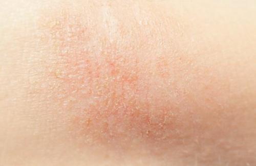 Атопический дерматит у взрослых лечение мазь. Что такое атопический дерматит?