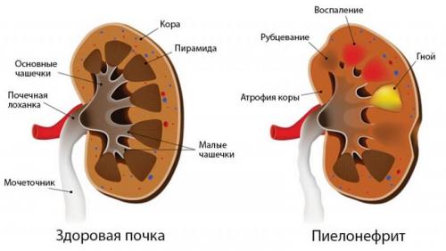 Неотложная помощь при остром пиелонефрите и гематурии. Неотложная помощь при гематурии 03 Неотложная помощь при остром пиелонефрите и гематурии. Неотложная помощь при гематурии 03